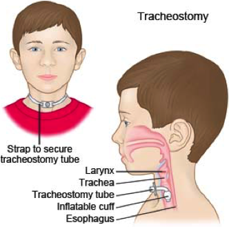 Thời điểm mở khí quản ở trẻ em