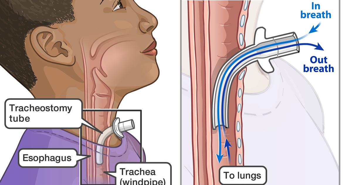 Phân biệt các loại ống mở khí quản trẻ em