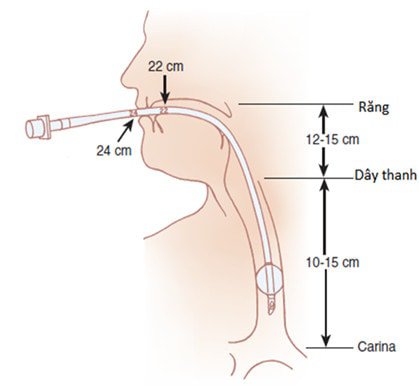 Đặt lại ống nội khí quản và nguy cơ viêm phổi so sánh với các nghiên cứu khác