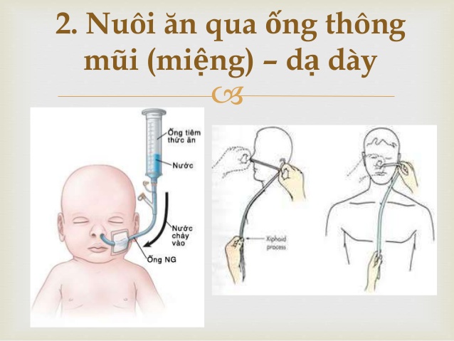 Dinh dưỡng qua ống thông