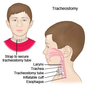 Thay ống mở khí quản phần 1