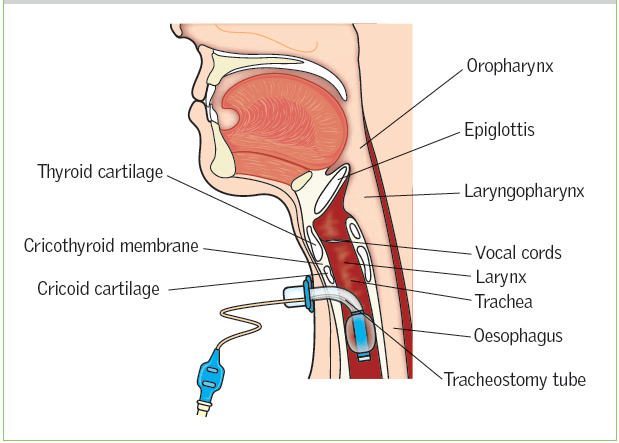Chăm sóc vết thương (Lỗ) mở khí quản