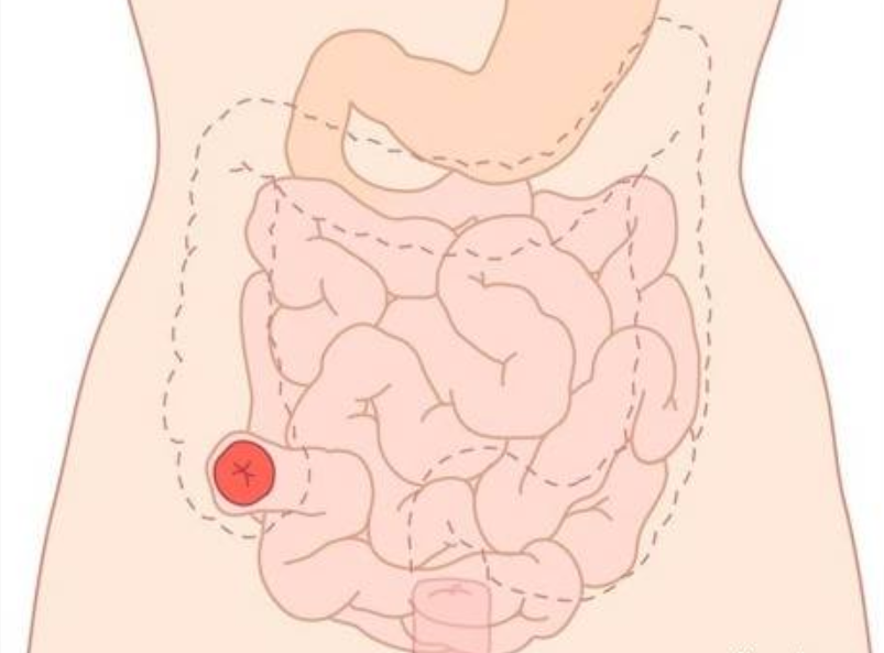 Các câu hỏi thường gặp với Hậu môn nhân tạo