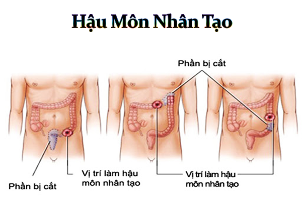 Tôi nên thay đổi hệ thống túi hậu môn nhân tạo của mình bao lâu một lần?