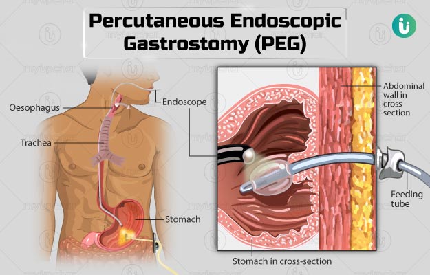 Mở thông dạ dày qua da – PEG
