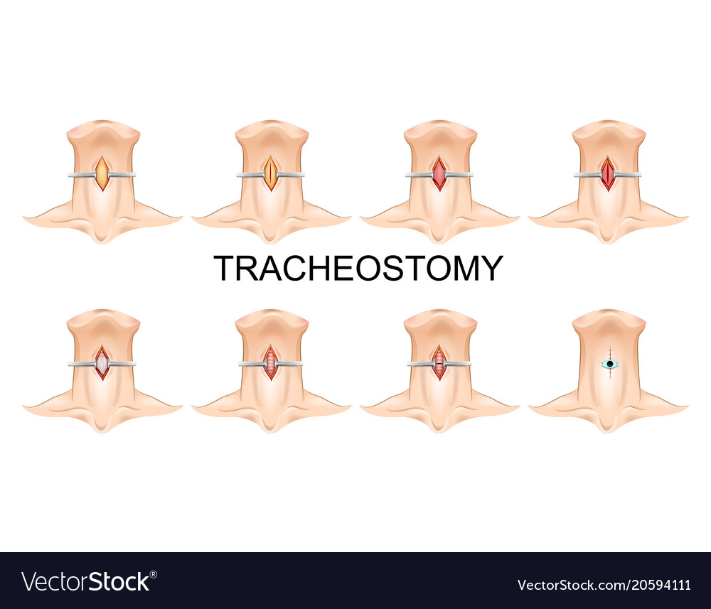 Các Thiết bị phụ trợ chăm sóc mở khí quản