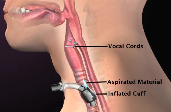 Các biến chứng và rủi ro của phẫu thuật mở khí quản