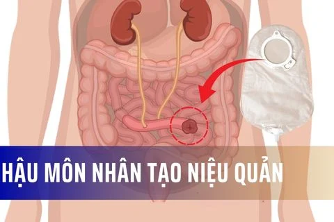 Hậu môn nhân tạo niệu quản: Những điều bạn cần biết