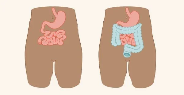 Điều gì chờ đón bạn sau phẫu thuật đóng hậu môn nhân tạo?