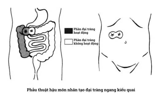 Tìm hiểu về các phẫu thuật hậu môn nhân tạo: vị trí và đặc điểm