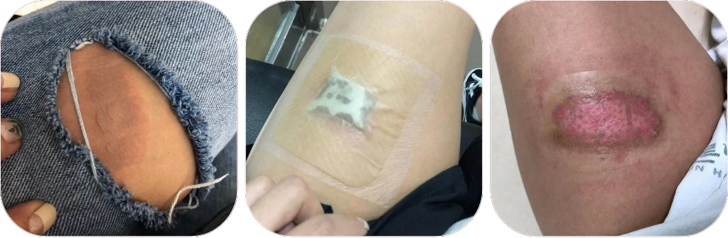 Bỏng độ 2 do máy ép tóc