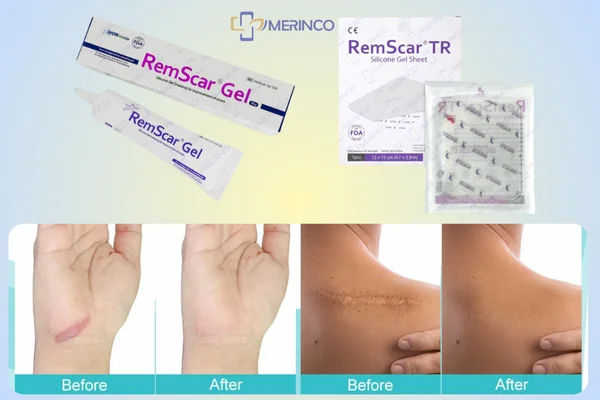silicone trị sẹo