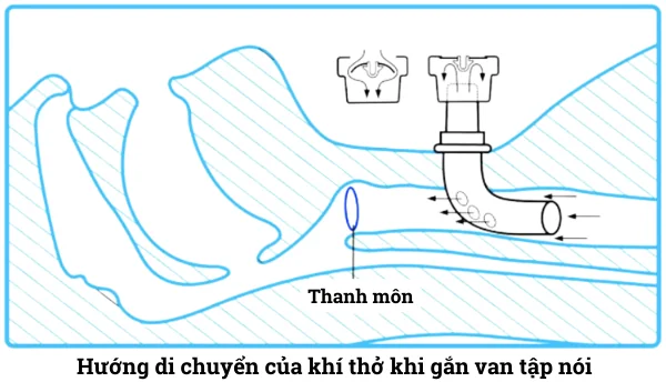 Cách thức hoạt động của van tập nói cho bệnh nhân mở khí quản