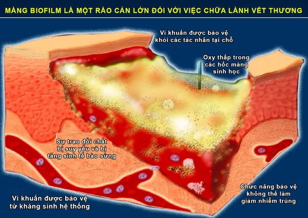Màng biofilm là một trong những rào cản lớn đối với việc chữa lành vết thương