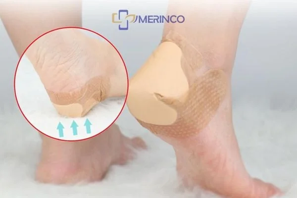 Cách điều trị và phòng ngừa loét da