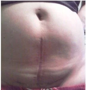 Sẹo mổ sau sinh: Hình ảnh vết mổ sau sinh bị lồi và Cách điều trị