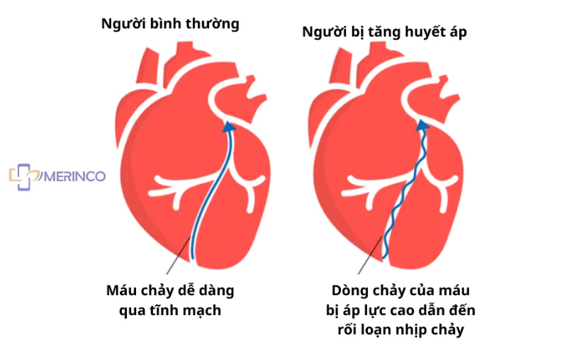 tăng huyết áp là gì