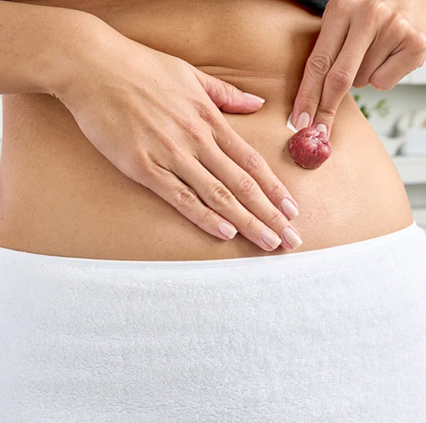 túi hmnt bị kích ứng