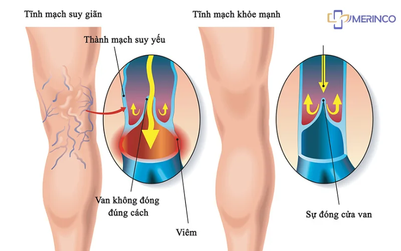 suy giãn tĩnh mạch