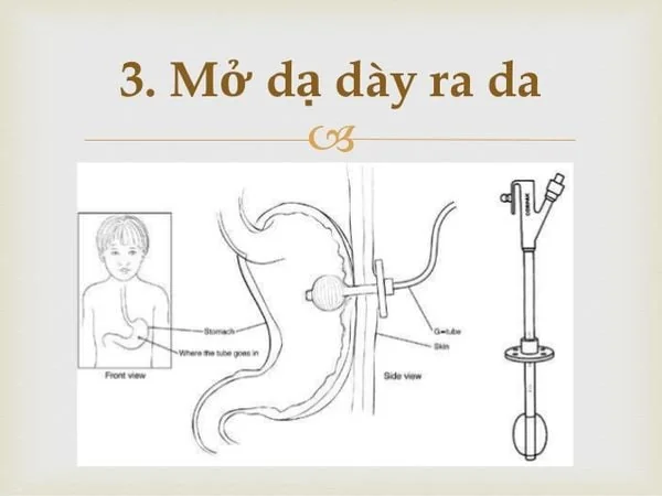 Ống thông dạ dày qua da