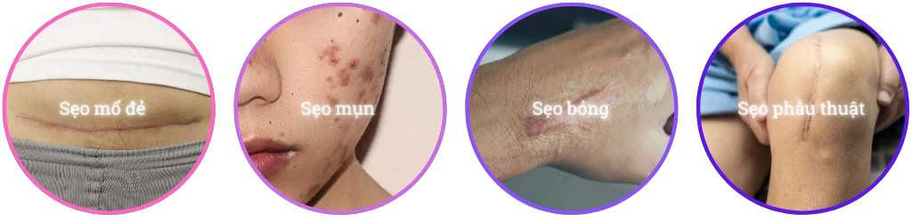 Kem gel silicone trị sẹo RemScar® Gel 15g hỗ trợ ngăn ngừa và điều trị sẹo