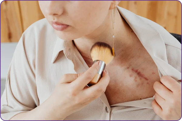 Hướng dẫn sử dụng Gel trị sẹo RemScar