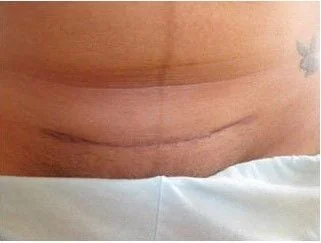 Sẹo mổ sau sinh: Hình ảnh vết mổ sau sinh bị lồi và Cách điều trị