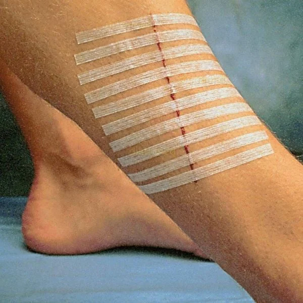 Miếng dán tránh giãn sẹo thay chỉ khâu 3M Steri Strip: Hướng dẫn sử dụng