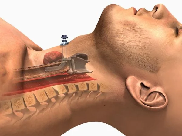 Các biến chứng và rủi ro của phẫu thuật mở khí quản