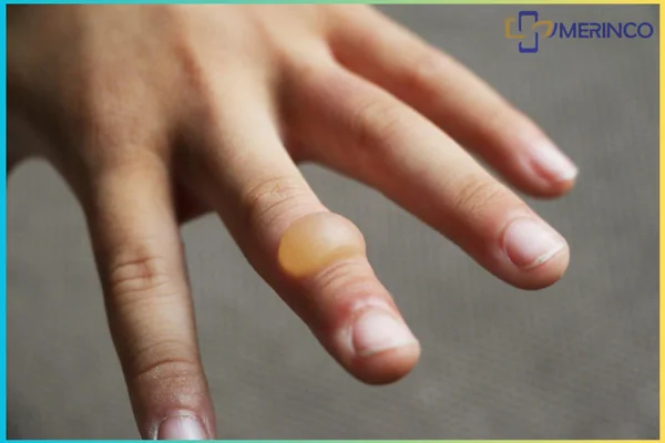 vết bỏng bị phồng rộp ở ngón tay