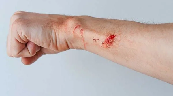 Cách vệ sinh vết thương hở hàng ngày