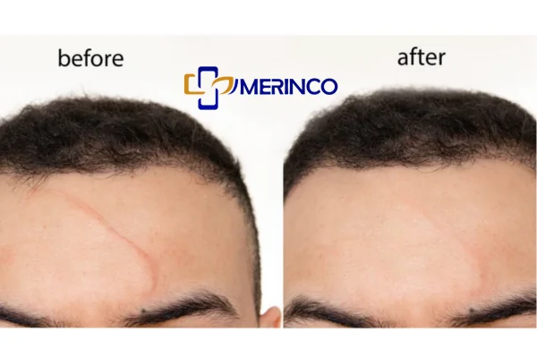 Hình ảnh sẹo phục hồi