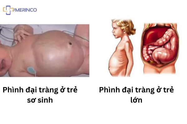 Phình đại tràng bẩm sinh ở trẻ