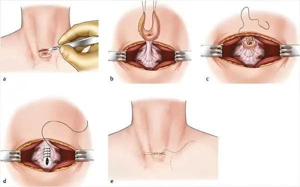 Cai ống mở khí quản - rút ống mở khí quản