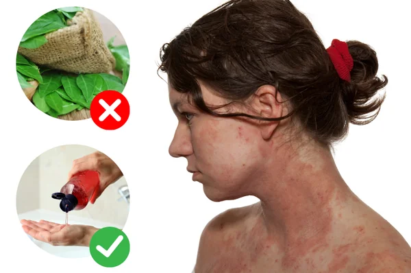 Phòng ngừa viêm da cơ địa thời điểm giao mùa