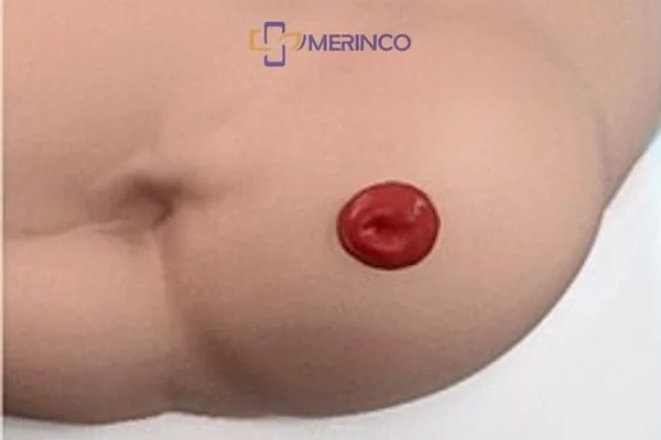 Biến chứng thường gặp ở hậu môn nhân tạo: Sa, thoát vị, tắc nghẽn