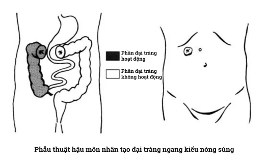 Tìm hiểu về các phẫu thuật hậu môn nhân tạo: vị trí và đặc điểm