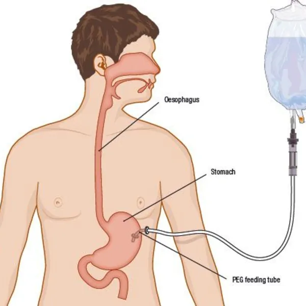 Tại sao phải đặt ống nuôi ăn đường ruột PEG? Những biến chứng của việc mở thông dạ dày qua da là gì?