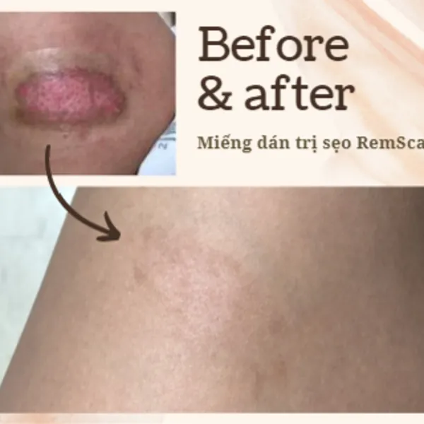 [Review] Mình đã trị sẹo thành công nhờ miếng dán sẹo RemScar TR