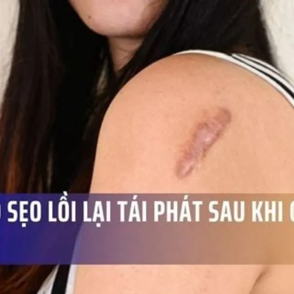 Tại Sao Sẹo Lồi Lại Tái Phát Sau Khi Cắt Bỏ?