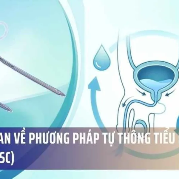 Tổng Quan Về Phương Pháp Tự Thông Tiểu Ngắt Quãng (ISC)