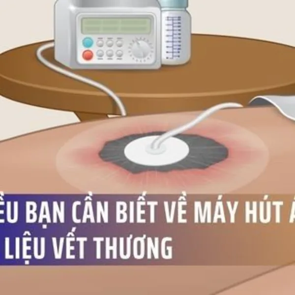 Mọi điều bạn cần biết về Máy hút áp lực âm trị liệu vết thương (Wound Vac)