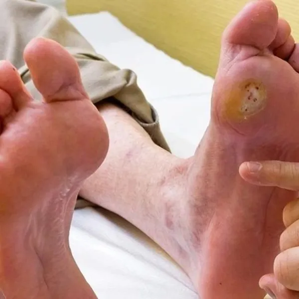 Triệu chứng và nguyên nhân gây loét do tiểu đường