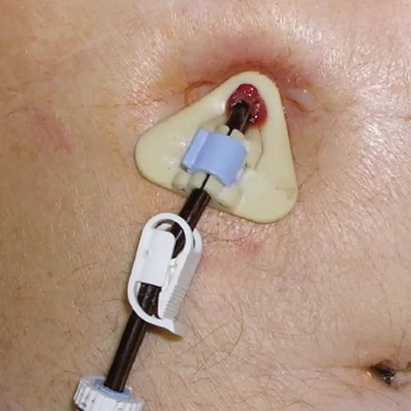 Quy trình đặt ống thông dạ dày và cách chăm sóc ống PEG