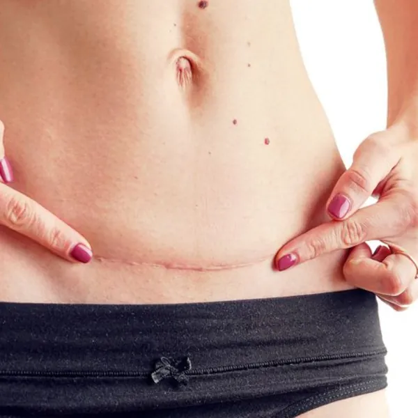 Tầm quan trọng của chăm sóc vết thương và chế độ dinh dưỡng cho mẹ sau sinh mổ