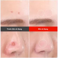 Miếng dán mụn mỏng Somaderm-Thin ngăn sẹo, giảm thâm (12 miếng)