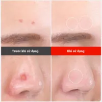 Miếng dán mụn Somaderm Spot - S ngăn ngừa sẹo do mụn (32 miếng)