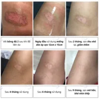 Miếng dán silicone trị sẹo RemScar® TR